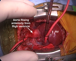 Vista de D-TGA del cirujano.