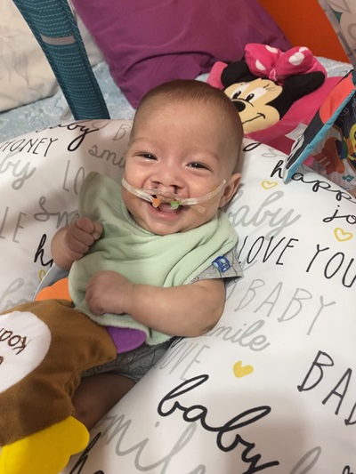 Jasiah de bebé antes de la cirugía