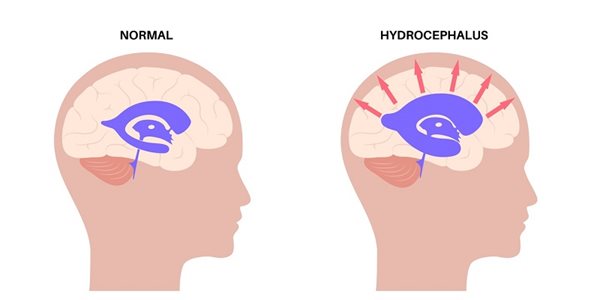 Infographic of hydrocephalus